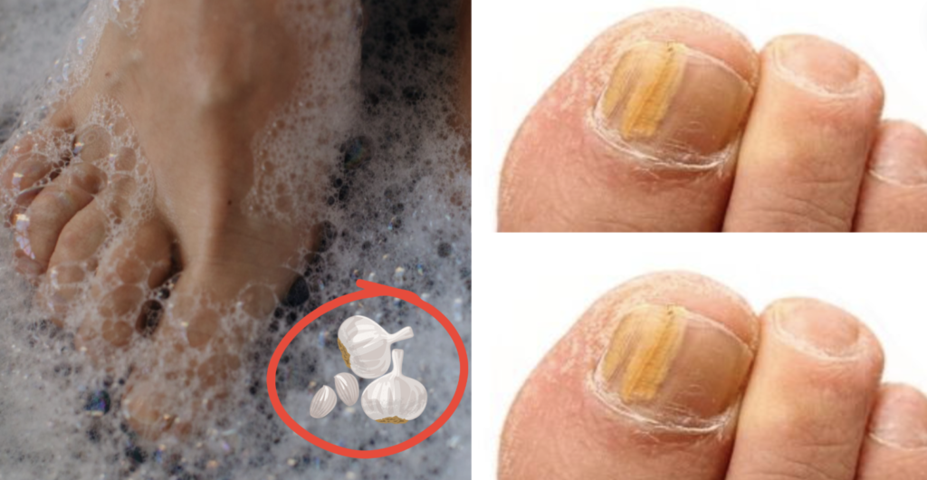 toe fungal infection