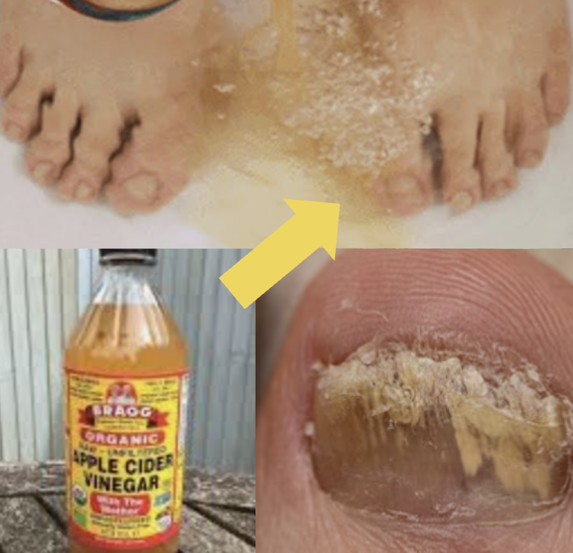 types of toenail fungus