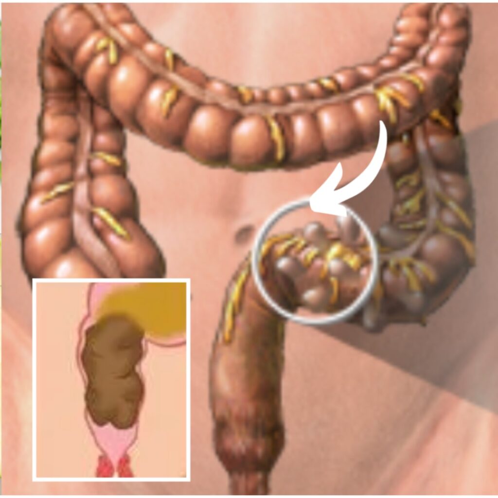 constipation remedies