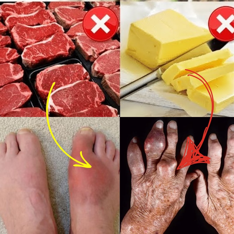 Foods to avoid for gout